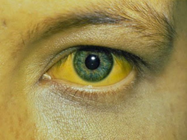 Hepatitis C Virus
