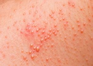 allergic rash on the body of the patient