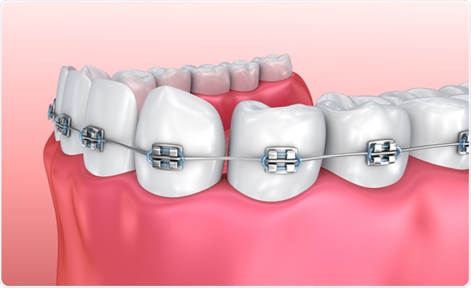 Is it Permitted to Use Braces?